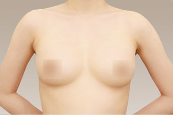 コンデンスリッチ豊胸の術後症例サンプル