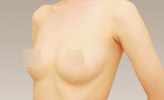 シリコンバック抜去+コンデンスリッチ豊胸の術後症例サンプル
