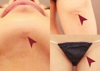 露出しても目立たない傷跡のイメージ