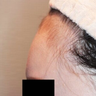 コンデンスリッチフェイス（おでこへの脂肪注入）【女性［27歳］5ヶ月】の術後写真