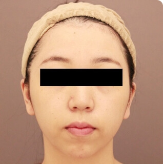 コンデンスリッチフェイス（頬のこけ）【女性/20歳】の術後写真