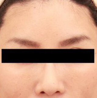 コンデンスリッチフェイス（目の下のクマ）の術後写真