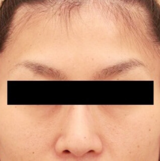 コンデンスリッチフェイス（目の下のクマ）の術前写真