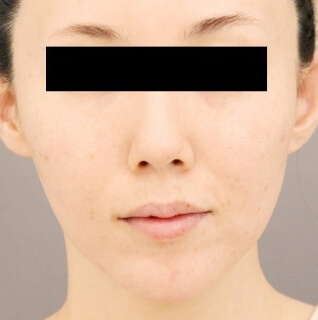 マイクロCRF注入（ほうれい線）の術後写真