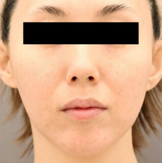 マイクロCRF注入（ほうれい線）の術前写真