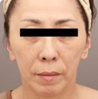 コンデンスリッチフェイス（フルフェイス）の術前写真