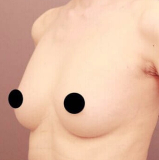 コンデンスリッチ豊胸【女性/23歳】の術後写真