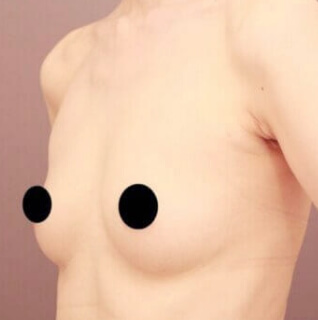 コンデンスリッチ豊胸【女性/23歳】の術前写真