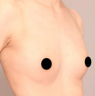 瘦せ型の方のコンデンスリッチ豊胸【女性［29歳］1ヶ月半】の術後写真