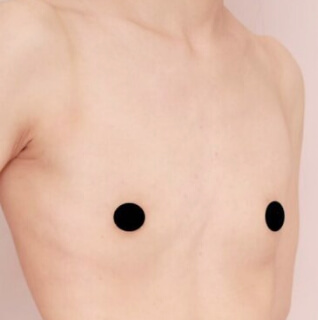 瘦せ型の方のコンデンスリッチ豊胸【女性［29歳］1ヶ月半】の術前写真