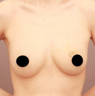 授乳後のコンデンスリッチ豊胸【女性/41歳】1ヶ月の術後写真