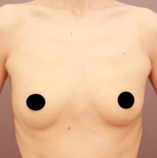 授乳後のコンデンスリッチ豊胸【女性/41歳】1ヶ月の術前写真