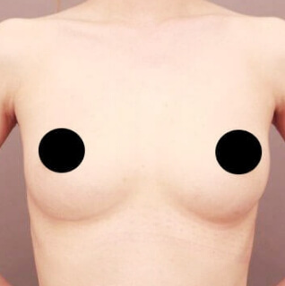 シリコンバック抜去＋コンデンスリッチ豊胸【女性/24歳】3ヶ月の術後写真