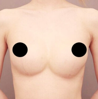 シリコンバック抜去＋コンデンスリッチ豊胸【女性/24歳】3ヶ月の術前写真