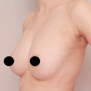 2回目のコンデンスリッチ豊胸【女性［32歳］3ヶ月】の術後写真