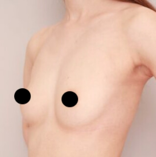 2回目のコンデンスリッチ豊胸【女性［32歳］3ヶ月】の術前写真