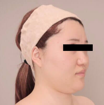 ベイザー脂肪吸引(頬＋あご下)【女性［27歳］3ヶ月】の術前写真