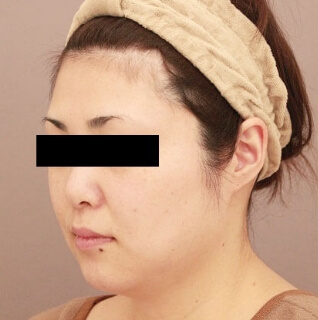 ベイザー脂肪吸引(頬＋あご下)【女性［36歳］3ヶ月】の術前写真