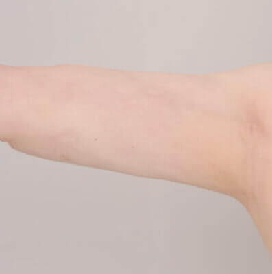 ベイザー脂肪吸引(二の腕＋肩)【女性［21歳］1ヶ月】の術後写真