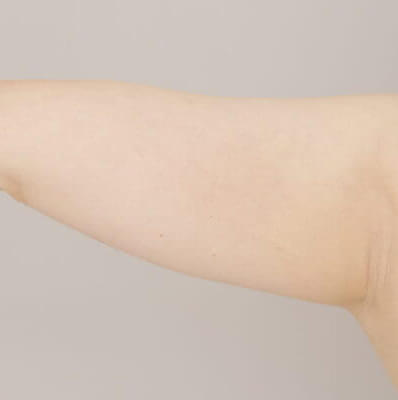 ベイザー脂肪吸引(二の腕＋肩)【女性［21歳］1ヶ月】の術前写真