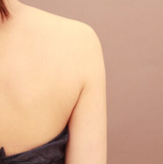 ベイザー脂肪吸引(二の腕＋肩)【女性［33歳］1ヶ月】の術後写真