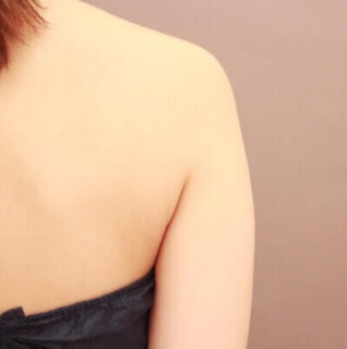 ベイザー脂肪吸引(二の腕＋肩)【女性［33歳］1ヶ月】の術前写真